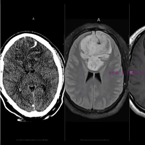 [AME]MRIOnline Imaging Mastery Series: Adult Glioma Imaging 2021 (CME VIDEOS) 