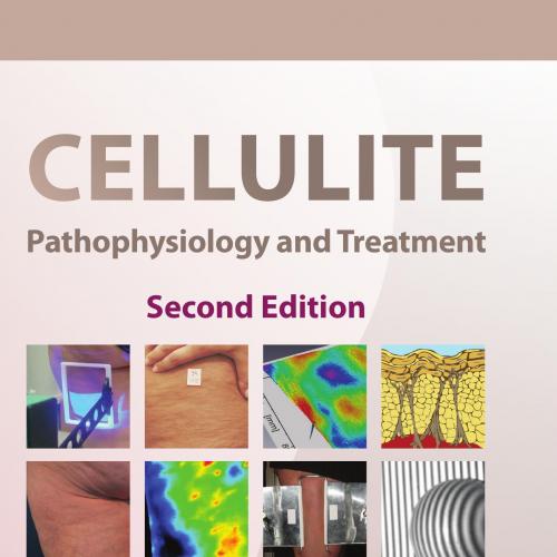 Cellulite Pathophysiology and Treatment 2nd Edition (Basic and Clinical Dermatology) - Mitchel P. Goldman, Doris Hexsel