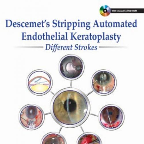 Descemet's Stripping Automated Endothelial Keratoplasty-Different Strokes - Wei Zhi